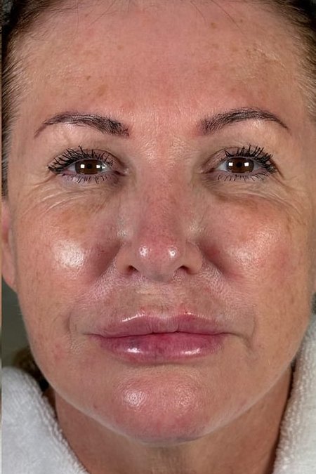 First full-face treatment, client in her sixties, after