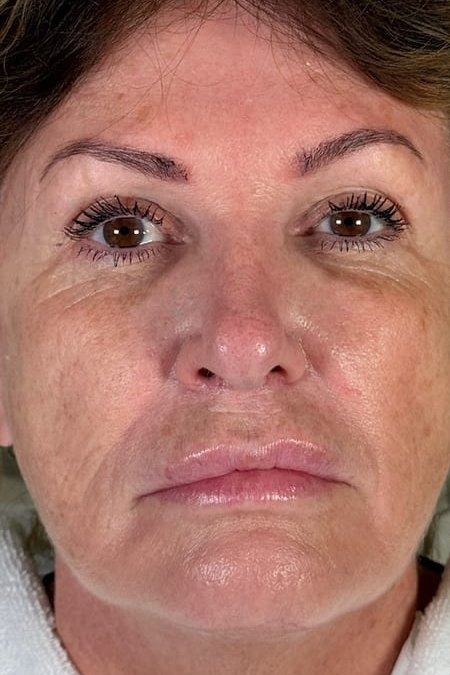 First full-face treatment, client in her sixties, before