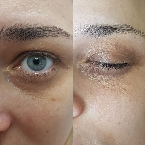 Carboxy Result Eyes