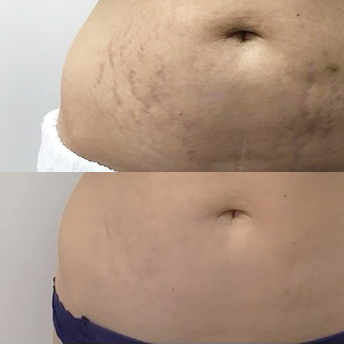 Carboxy Result Stretch Marks